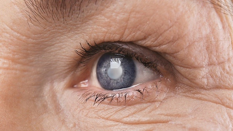 Närbild på ett öga med glaukom. En blå iris med ett mjölkigt töcken över pupillen